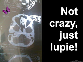 Image: brain scan.  Text: Not crazy, just lupie!
